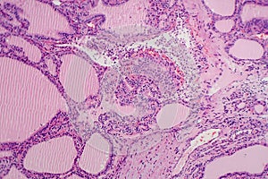 Histopathology of Endemic goitre