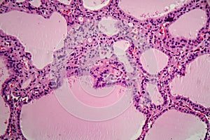 Histopathology of Endemic goitre