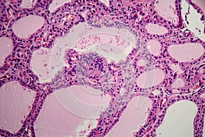 Histopathology of Endemic goitre