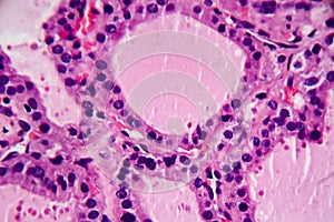 Histopathology of Endemic goitre