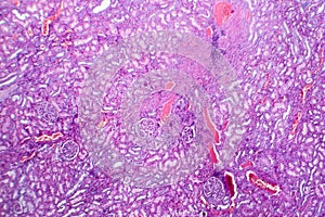 Histopathology of hypertensive renal disease, light micrograph