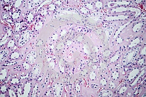 Histopathology of hypertensive renal disease, light micrograph