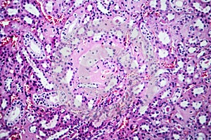 Histopathology of hypertensive renal disease, light micrograph