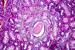 Histopathology of hypertensive renal disease, light micrograph