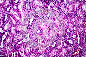 Histopathology of hypertensive renal disease, light micrograph