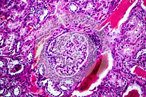 Histopathology of hypertensive renal disease, light micrograph