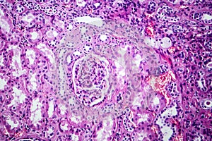 Histopathology of hypertensive renal disease, light micrograph