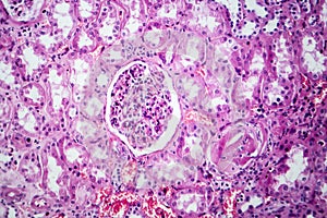 Histopathology of hypertensive renal disease, light micrograph