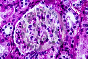 Histopathology of hypertensive renal disease, light micrograph