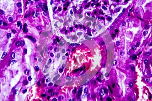 Histopathology of hypertensive renal disease, light micrograph