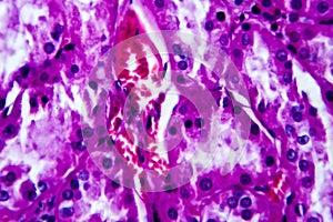 Histopathology of hypertensive renal disease, light micrograph