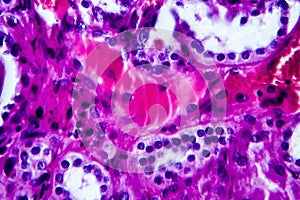 Histopathology of hypertensive renal disease, light micrograph