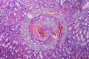 Histopathology of hypertensive renal disease, light micrograph