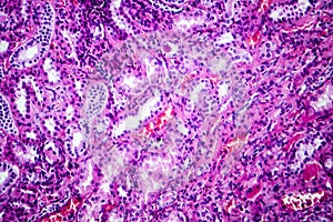 Histopathology of hypertensive renal disease, light micrograph