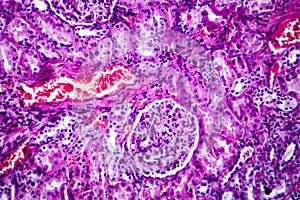 Histopathology of hypertensive renal disease, light micrograph