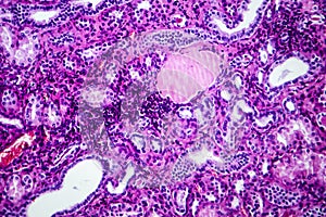 Histopathology of hypertensive renal disease, light micrograph