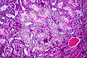 Histopathology of hypertensive renal disease, light micrograph