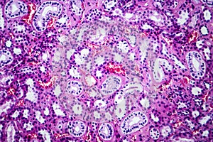 Histopathology of hypertensive renal disease, light micrograph