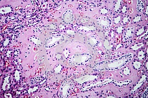 Histopathology of hypertensive renal disease, light micrograph