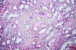 Histopathology of hypertensive renal disease, light micrograph