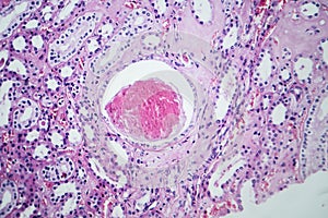 Histopathology of hypertensive renal disease, light micrograph