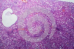 Histopathology of hypertensive renal disease, light micrograph photo