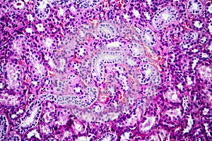 Histopathology of hypertensive renal disease, light micrograph photo