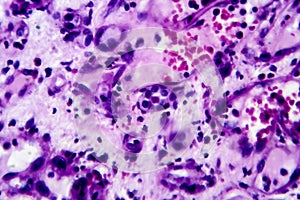 Histopathology of interstitial nephritis