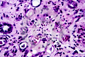 Histopathology of interstitial nephritis