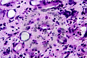 Histopathology of interstitial nephritis