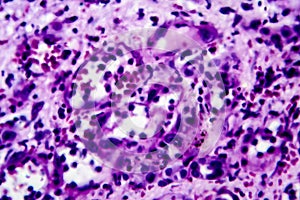 Histopathology of interstitial nephritis