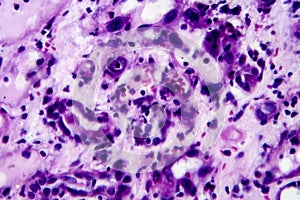 Histopathology of interstitial nephritis