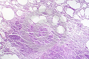 Histopathology of interstitial pneumonia photo