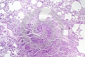 Histopathology of interstitial pneumonia photo