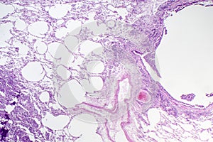 Histopathology of interstitial pneumonia photo