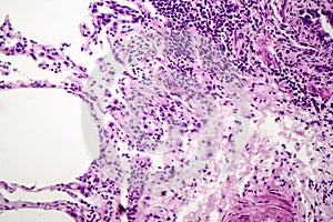 Histopathology of interstitial pneumonia photo