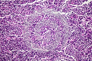 Histopathology of interstitial pneumonia photo