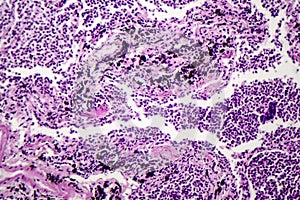 Histopathology of interstitial pneumonia photo