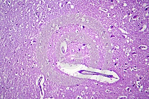 Histopathology of Japanese encephalitis, light micrograph photo