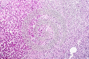 Histopathology of liver abscess