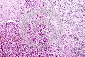 Histopathology of liver abscess