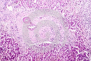 Histopathology of liver abscess