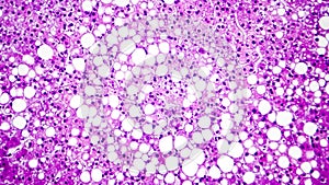 Histopathology of liver steatosis, or fatty liver photo