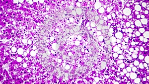 Histopathology of liver steatosis, or fatty liver