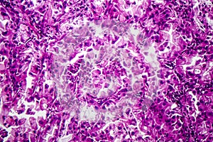 Histopathology of lung cancer