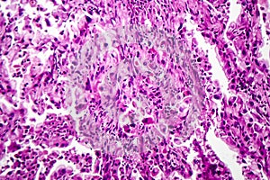 Histopathology of lung cancer photo