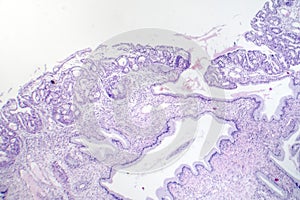 Histopathology of nasal polyps