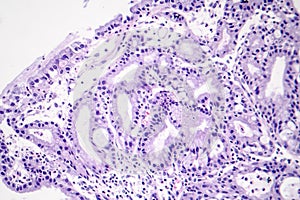 Histopathology of nasal polyps
