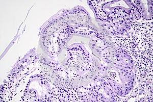 Histopathology of nasal polyps