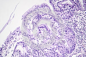 Histopathology of nasal polyps photo